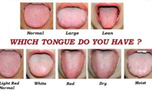 Tcm Tongue Diagnosis Chart